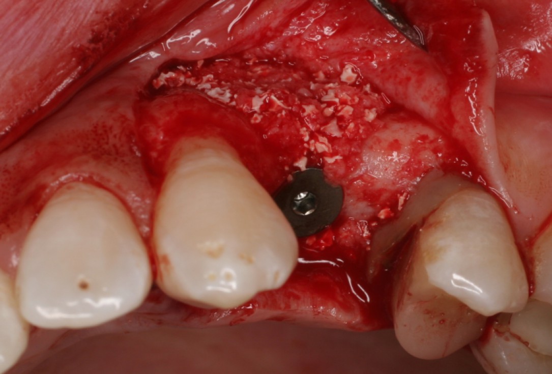 botiss cerabone® & Jason® membrane for horizontal augmentation - clinical case by Prof. Dr. Dr. D. Rothamel