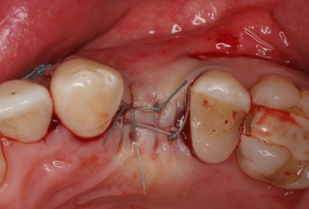 botiss cerabone® & Jason® membrane for horizontal augmentation - clinical case by Prof. Dr. Dr. D. Rothamel
