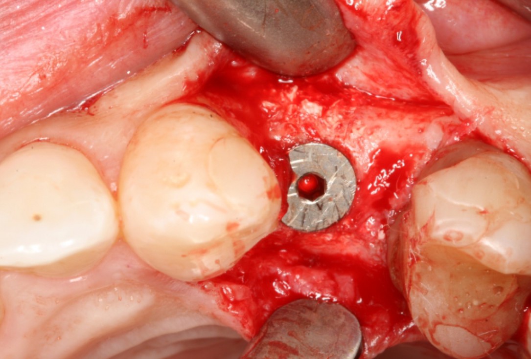 botiss cerabone® & Jason® membrane for horizontal augmentation - clinical case by Prof. Dr. Dr. D. Rothamel