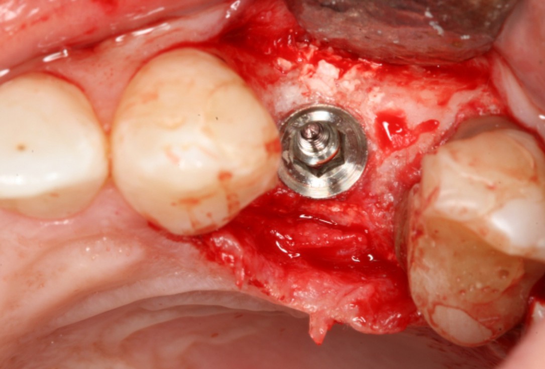 botiss cerabone® & Jason® membrane for horizontal augmentation - clinical case by Prof. Dr. Dr. D. Rothamel