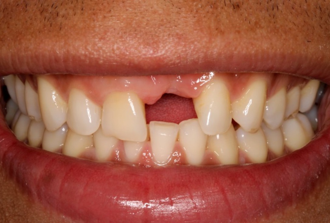 botiss cerabone® & Jason® membrane for block augmentation with autologous bone blocks - clinical case by Dr. S. Stavar