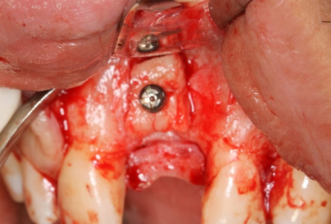 botiss cerabone® & Jason® membrane for block augmentation with autologous bone blocks - clinical case by Dr. S. Stavar