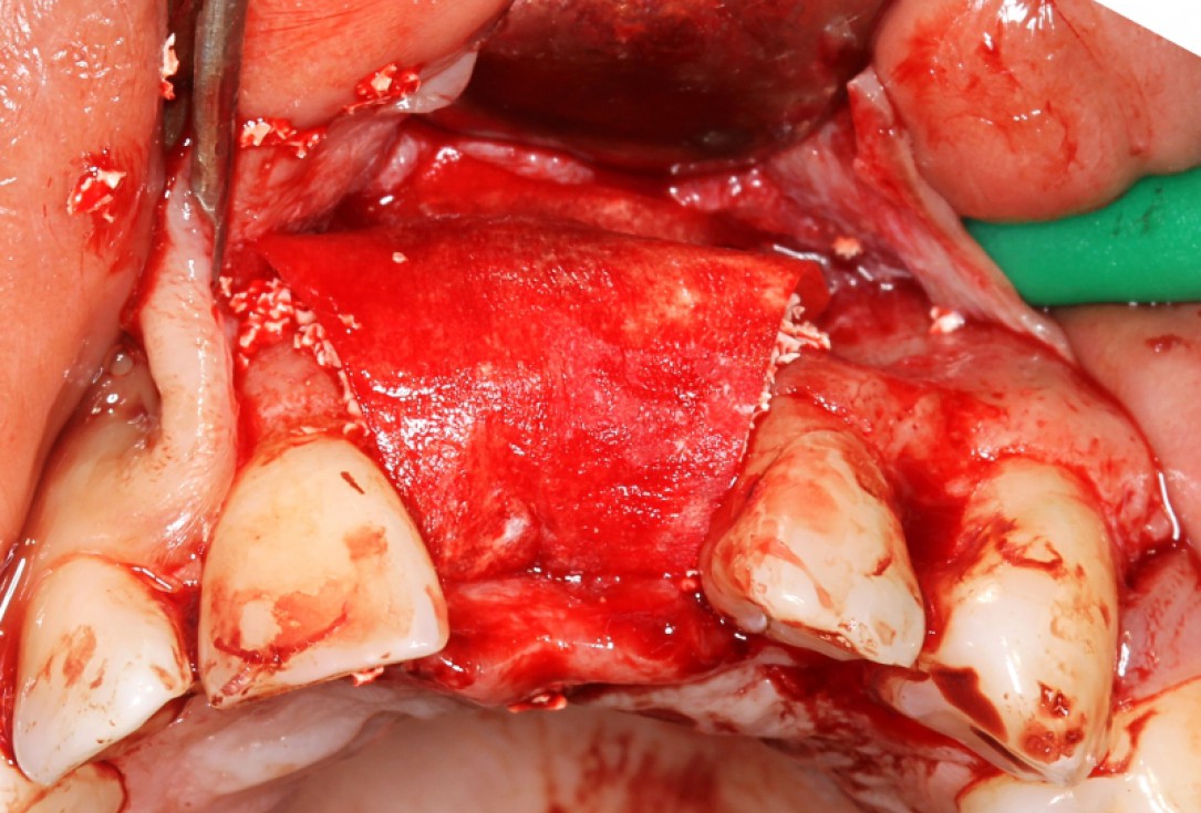 botiss cerabone® & Jason® membrane for block augmentation with autologous bone blocks - clinical case by Dr. S. Stavar