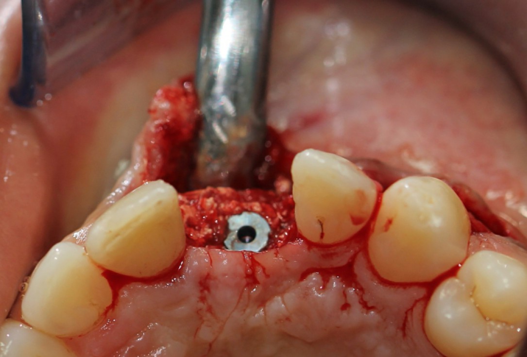 botiss cerabone® & Jason® membrane for block augmentation with autologous bone blocks - clinical case by Dr. S. Stavar