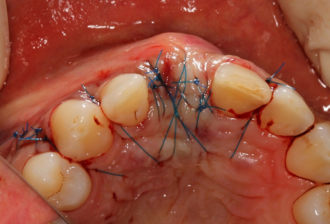 botiss cerabone® & Jason® membrane for block augmentation with autologous bone blocks - clinical case by Dr. S. Stavar