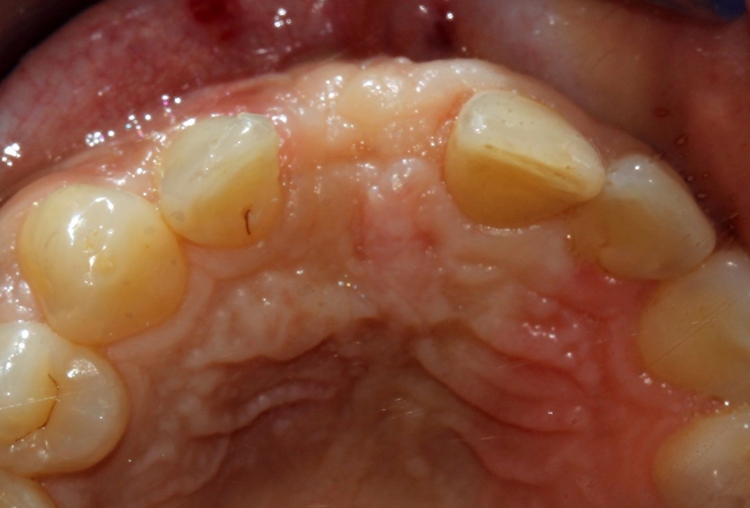 botiss cerabone® & Jason® membrane for block augmentation with autologous bone blocks - clinical case by Dr. S. Stavar