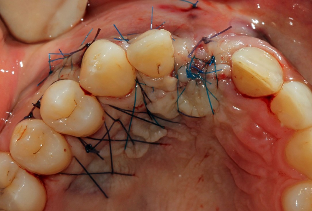 botiss cerabone® & Jason® membrane for block augmentation with autologous bone blocks - clinical case by Dr. S. Stavar