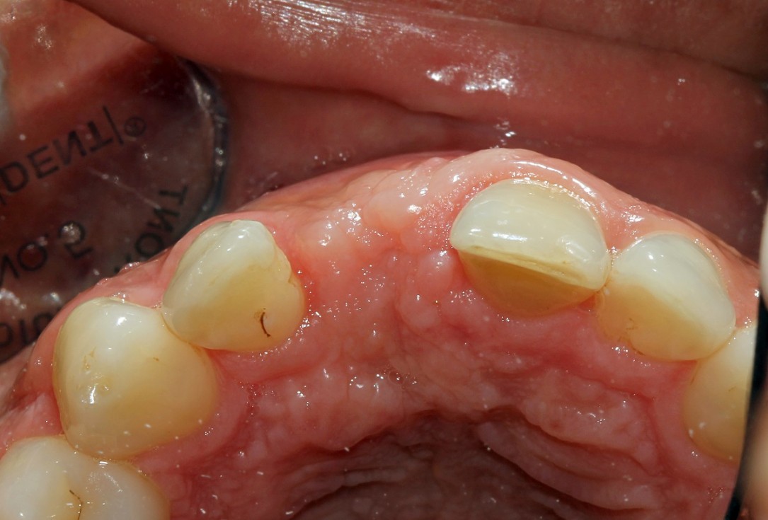 botiss cerabone® & Jason® membrane for block augmentation with autologous bone blocks - clinical case by Dr. S. Stavar