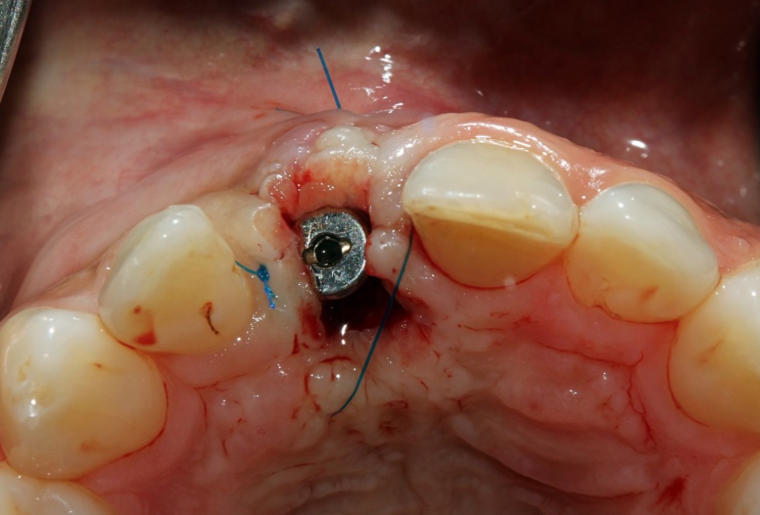 botiss cerabone® & Jason® membrane for block augmentation with autologous bone blocks - clinical case by Dr. S. Stavar
