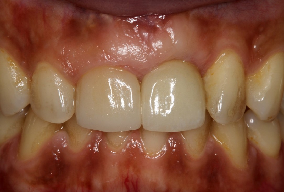 botiss cerabone® & Jason® membrane for block augmentation with autologous bone blocks - clinical case by Dr. S. Stavar