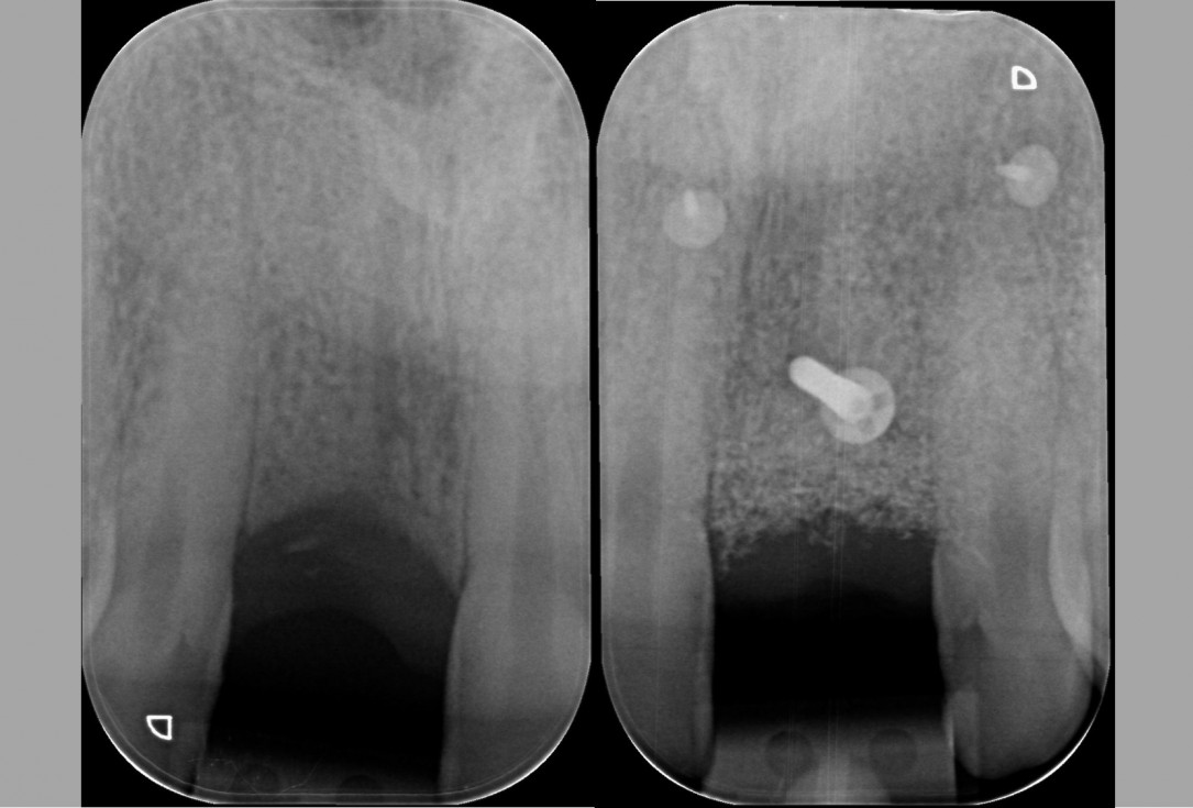 botiss cerabone® & Jason® membrane for block augmentation with autologous bone blocks - clinical case by Dr. S. Stavar