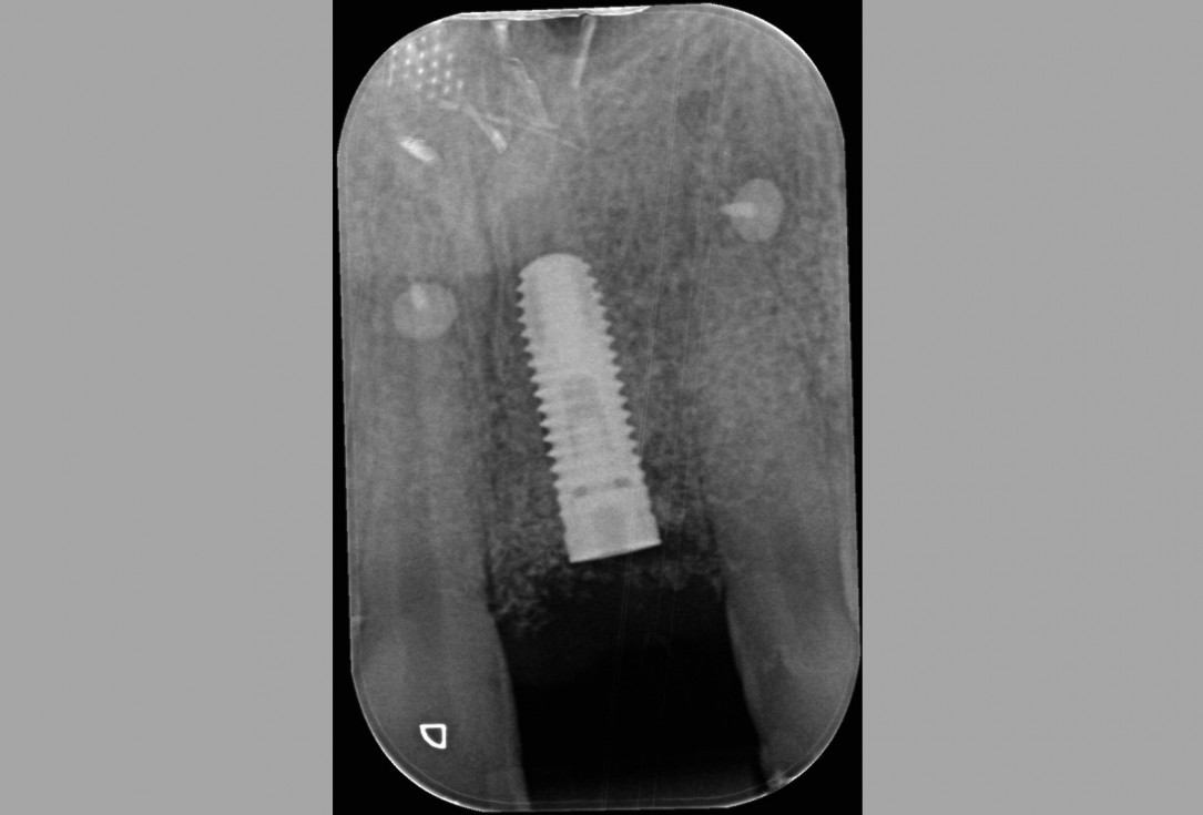 botiss cerabone® & Jason® membrane for block augmentation with autologous bone blocks - clinical case by Dr. S. Stavar