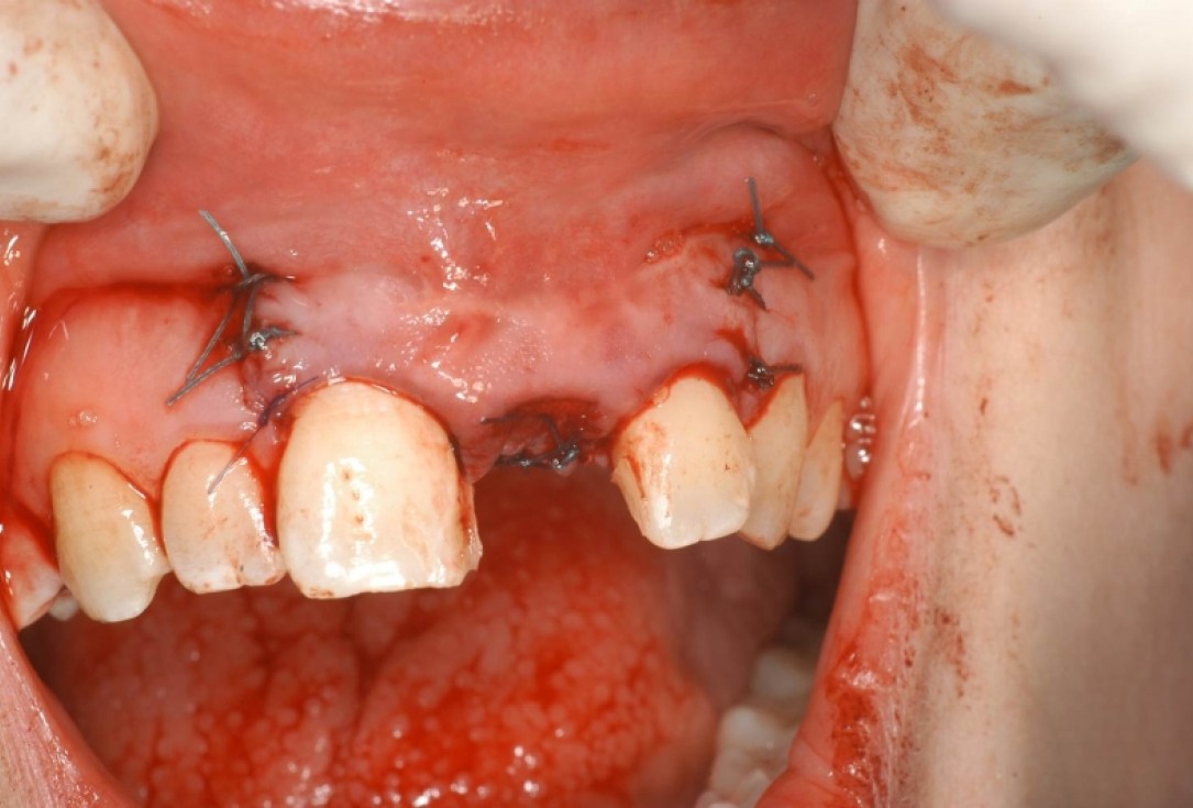 botiss cerabone® & Jason® membrane for treatment of dehiscence defect - Clinical case by Dr. M. Steigmann
