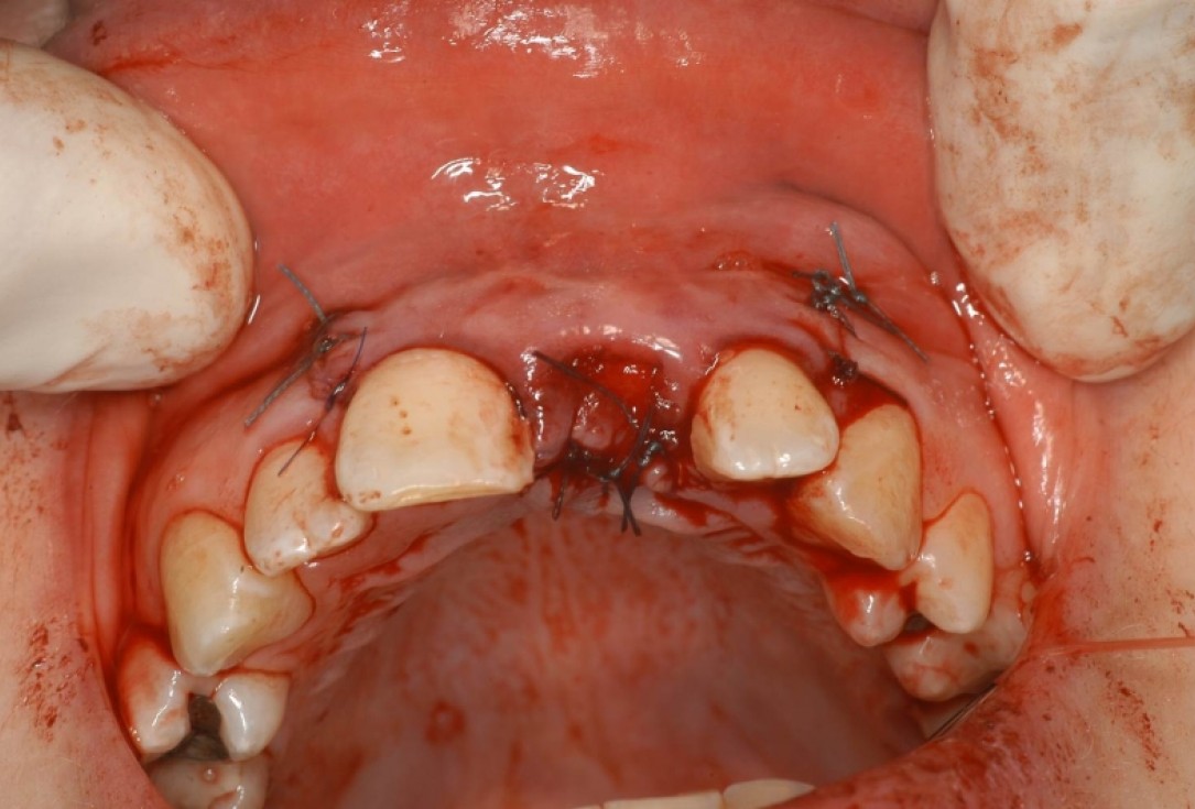 botiss cerabone® & Jason® membrane for treatment of dehiscence defect - Clinical case by Dr. M. Steigmann