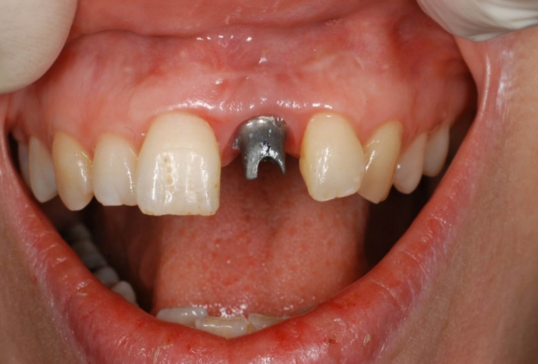 botiss cerabone® & Jason® membrane for treatment of dehiscence defect - Clinical case by Dr. M. Steigmann