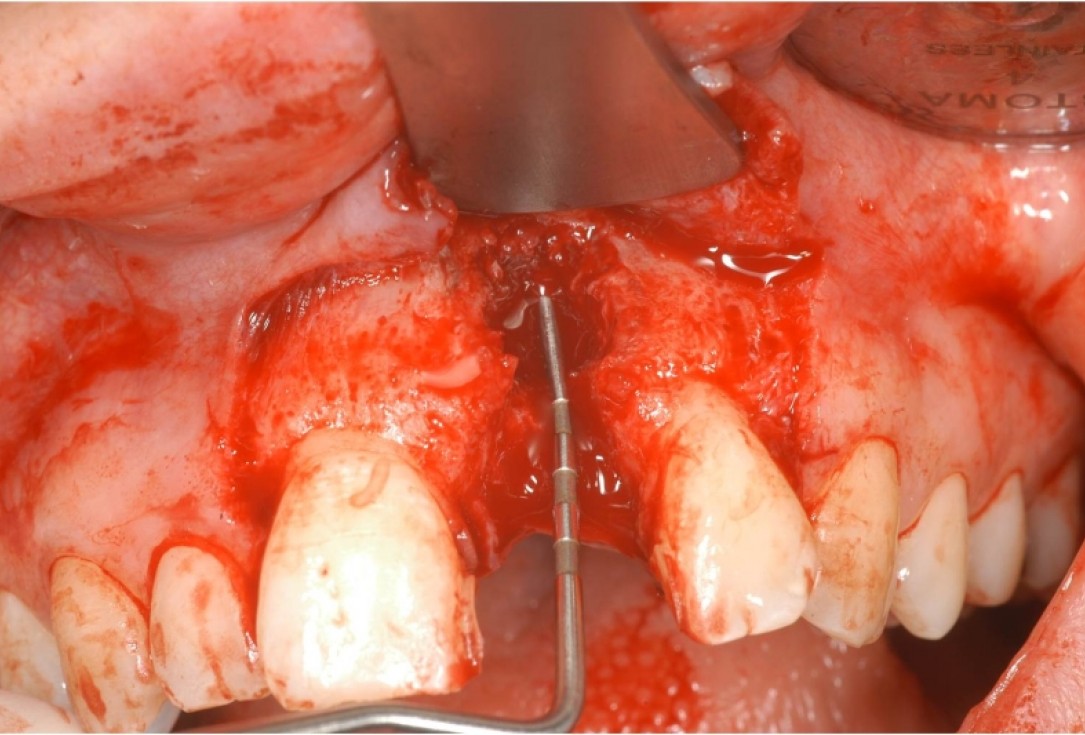 botiss cerabone® & Jason® membrane for treatment of dehiscence defect - Clinical case by Dr. M. Steigmann