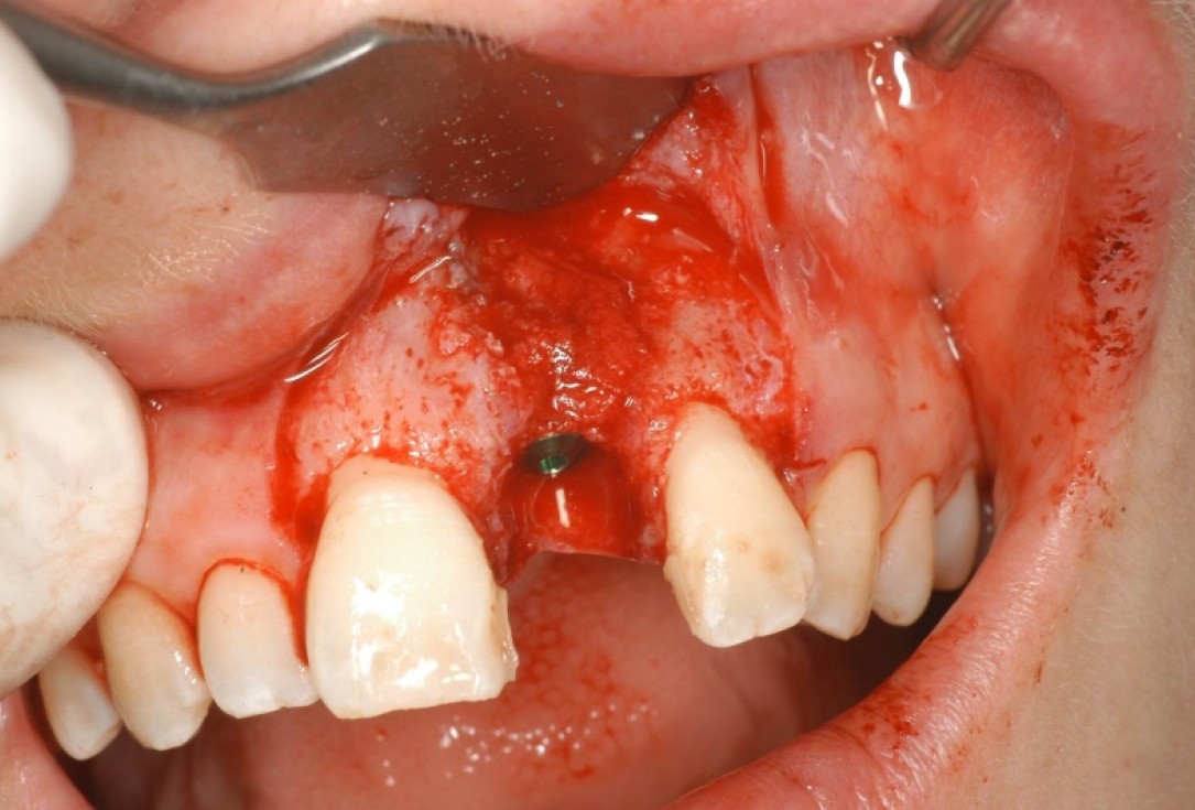 botiss cerabone® & Jason® membrane for treatment of dehiscence defect - Clinical case by Dr. M. Steigmann