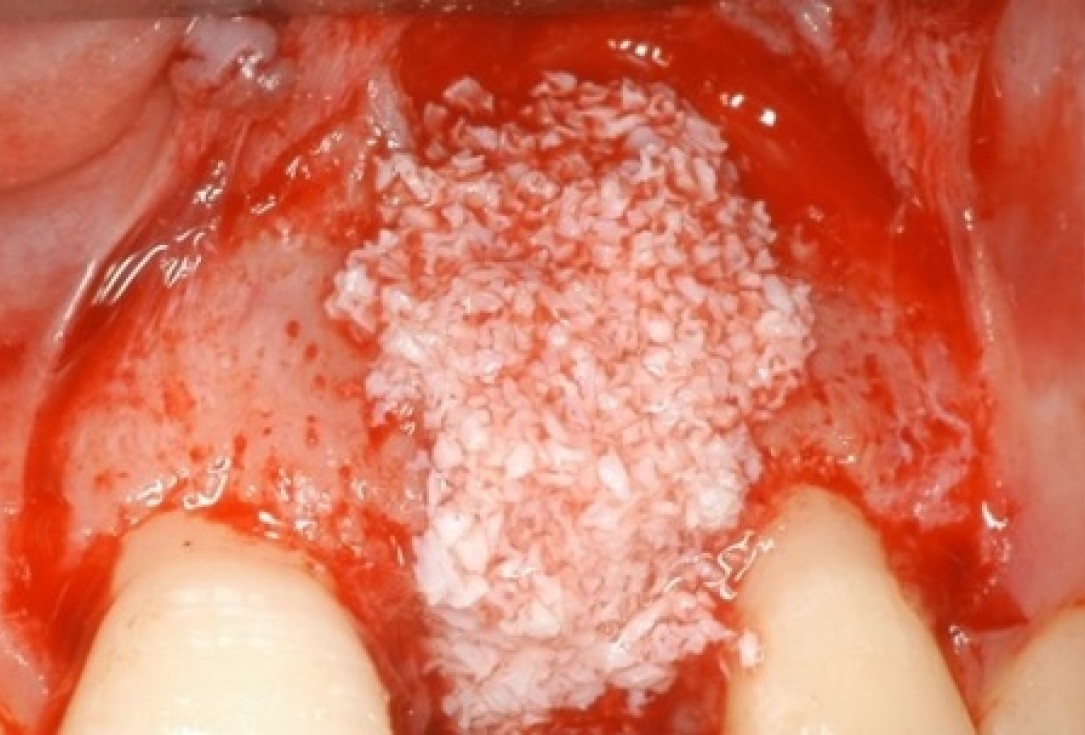 botiss cerabone® & Jason® membrane for treatment of dehiscence defect - Clinical case by Dr. M. Steigmann