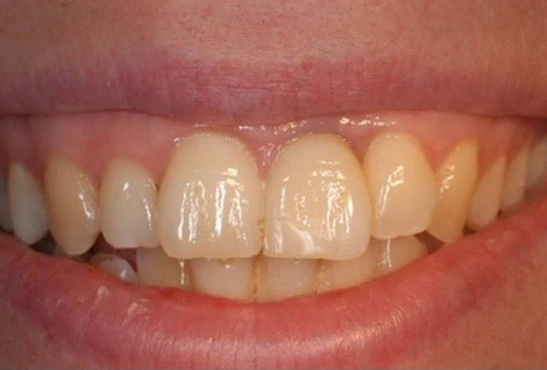 botiss cerabone® & Jason® membrane for treatment of dehiscence defect - Clinical case by Dr. M. Steigmann