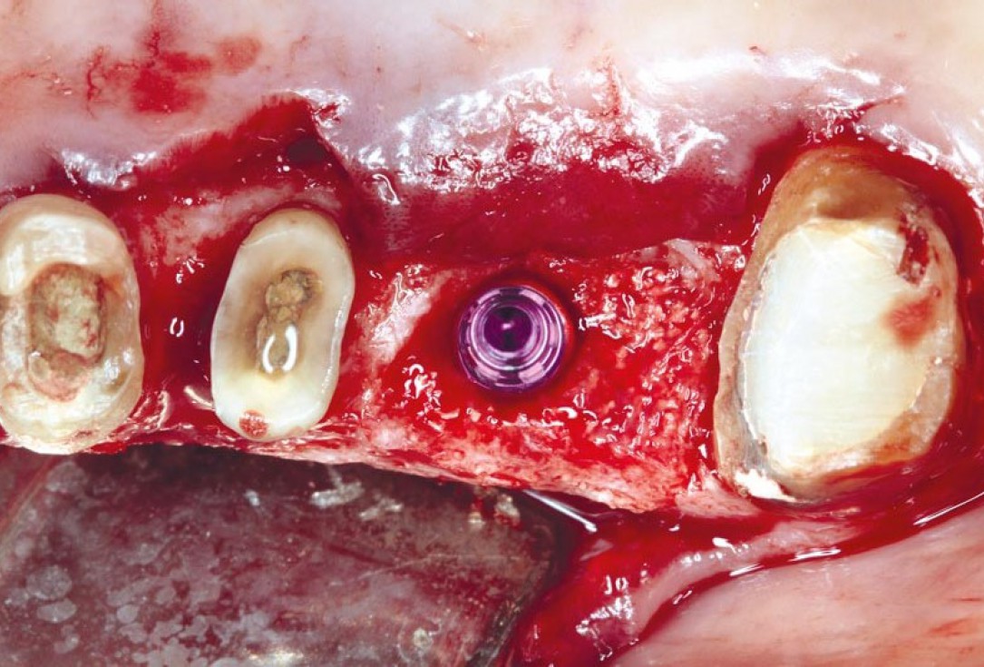 Ridge augmentation using cerabone®, Jason® membrane and Straumann® Emdogain® - Dr. S. Pelekanos