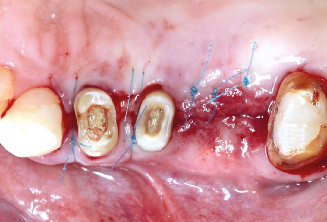 Ridge augmentation using cerabone®, Jason® membrane and Straumann® Emdogain® - Dr. S. Pelekanos