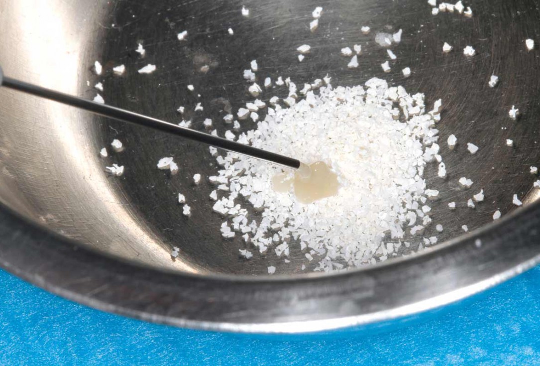 Ridge augmentation using cerabone®, Jason® membrane and Straumann® Emdogain® - Dr. S. Pelekanos