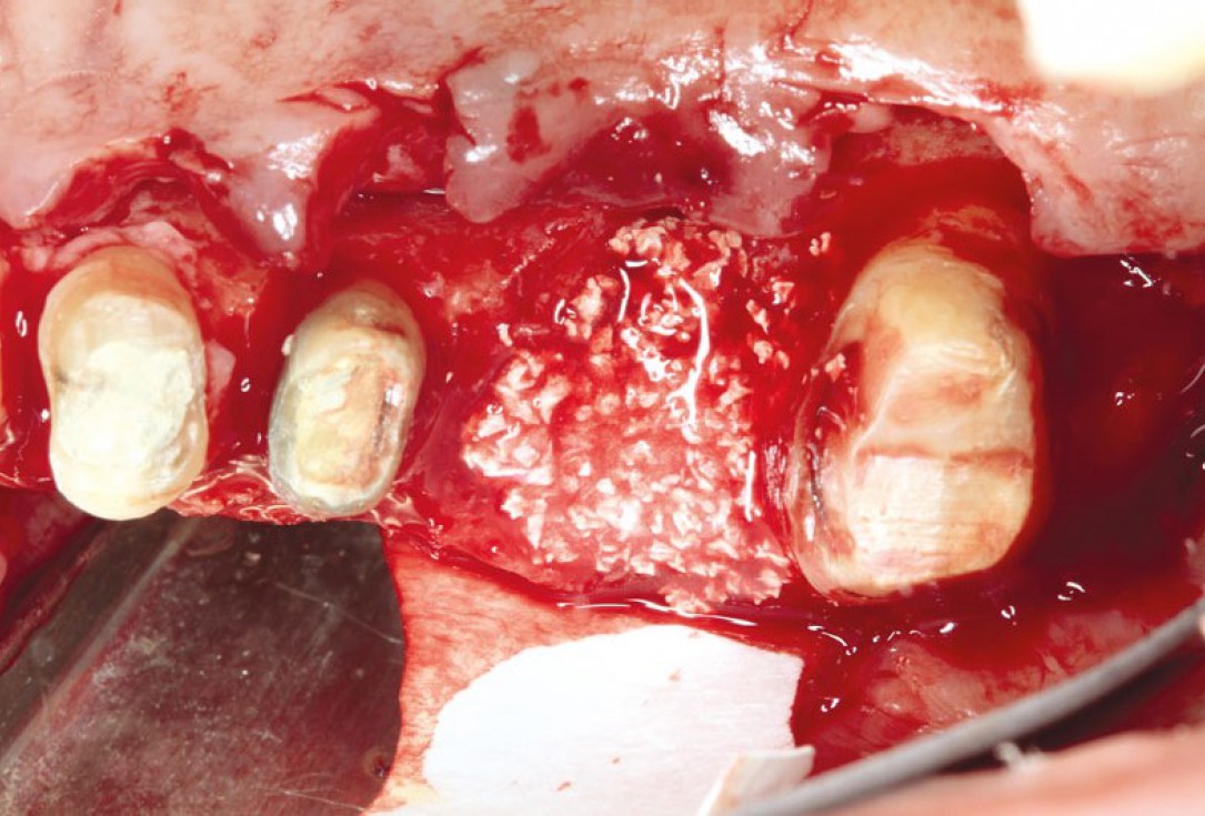 Ridge augmentation using cerabone®, Jason® membrane and Straumann® Emdogain® - Dr. S. Pelekanos