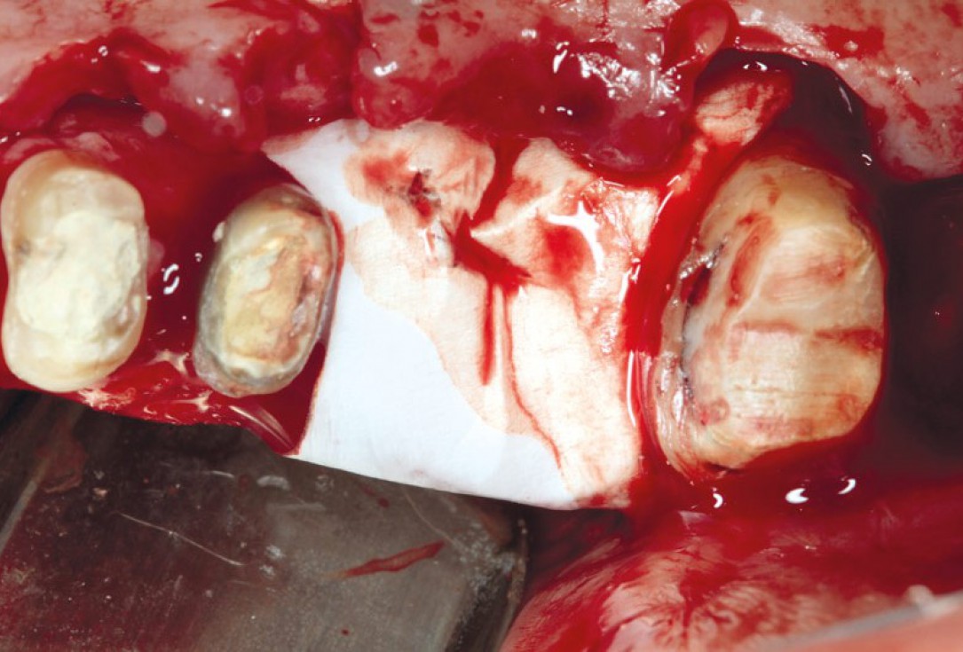 Ridge augmentation using cerabone®, Jason® membrane and Straumann® Emdogain® - Dr. S. Pelekanos