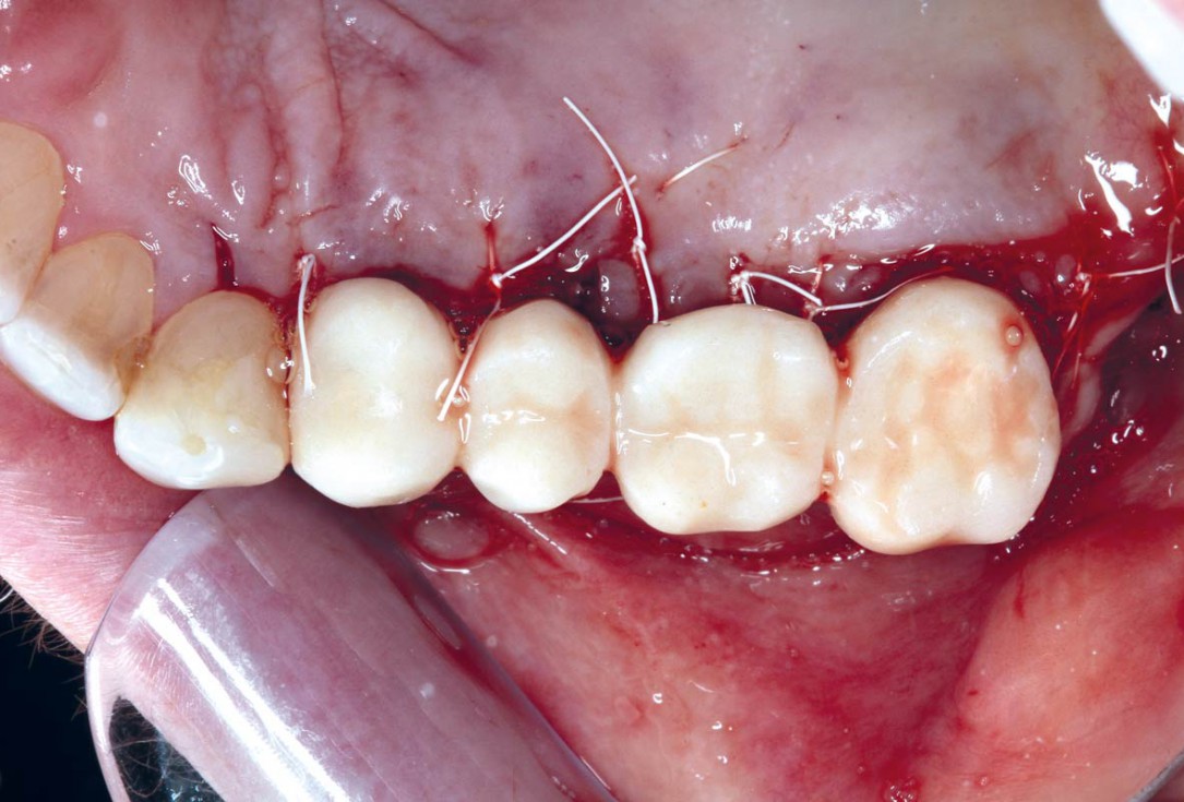 Ridge augmentation using cerabone®, Jason® membrane and Straumann® Emdogain® - Dr. S. Pelekanos