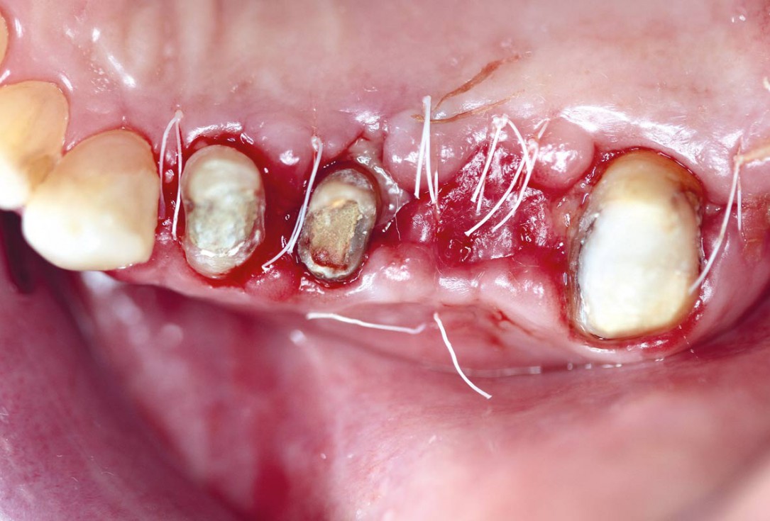 Ridge augmentation using cerabone®, Jason® membrane and Straumann® Emdogain® - Dr. S. Pelekanos