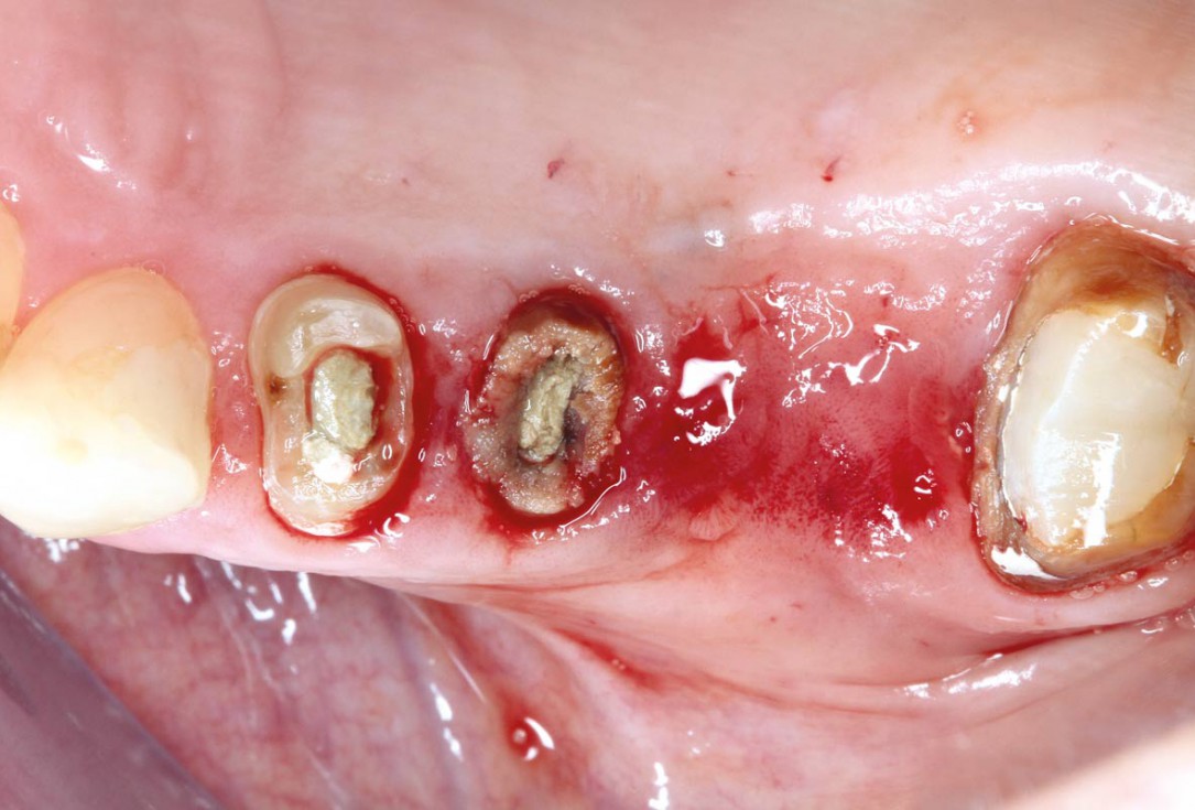 Ridge augmentation using cerabone®, Jason® membrane and Straumann® Emdogain® - Dr. S. Pelekanos