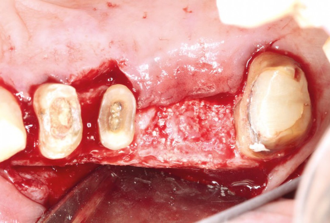 Ridge augmentation using cerabone®, Jason® membrane and Straumann® Emdogain® - Dr. S. Pelekanos