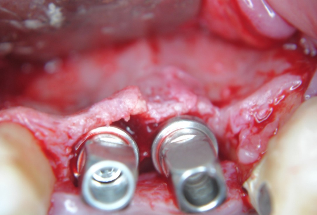 botiss cerabone® & Jason® membrane for GBR - Clinical case by Dr. S. Kovalevsky