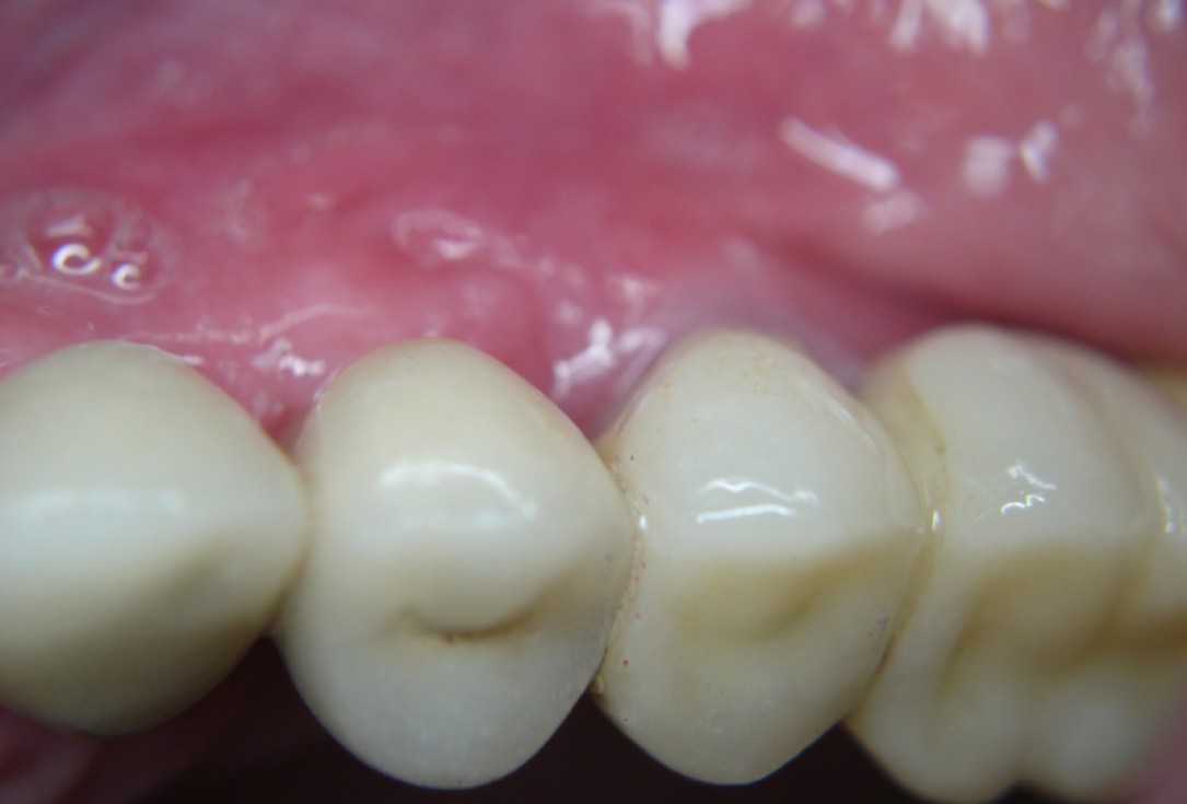 botiss cerabone® & Jason® membrane for GBR - Clinical case by Dr. S. Kovalevsky