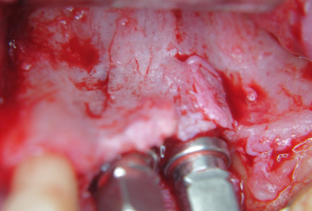 botiss cerabone® & Jason® membrane for GBR - Clinical case by Dr. S. Kovalevsky