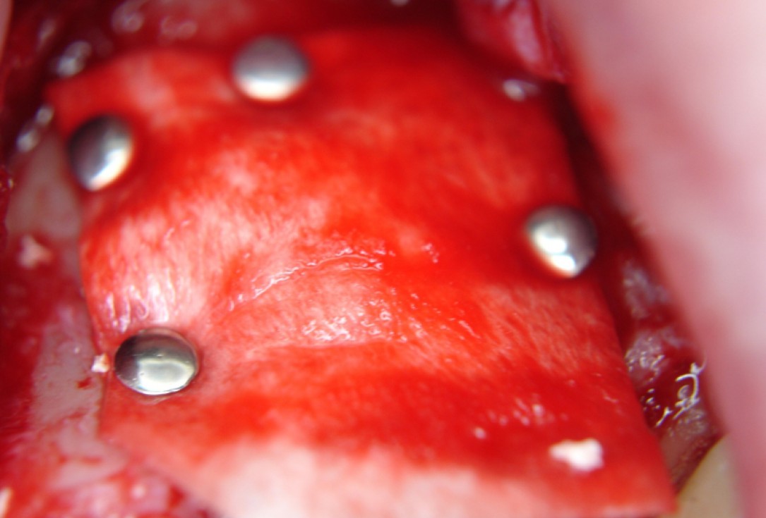 botiss cerabone® & Jason® membrane for GBR - Clinical case by Dr. S. Kovalevsky