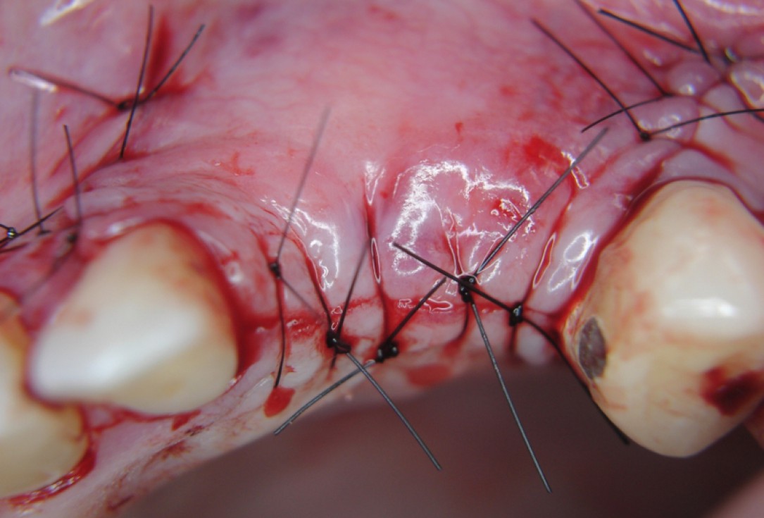 botiss cerabone® & Jason® membrane for GBR - Clinical case by Dr. S. Kovalevsky