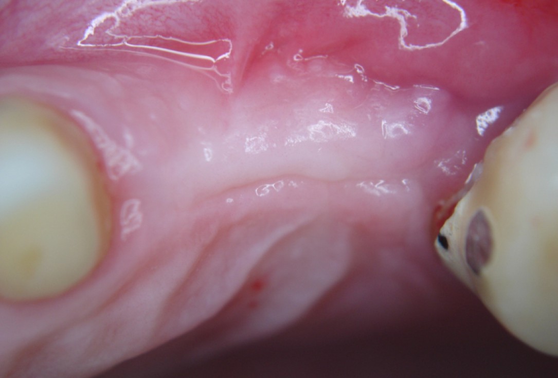 botiss cerabone® & Jason® membrane for GBR - Clinical case by Dr. S. Kovalevsky