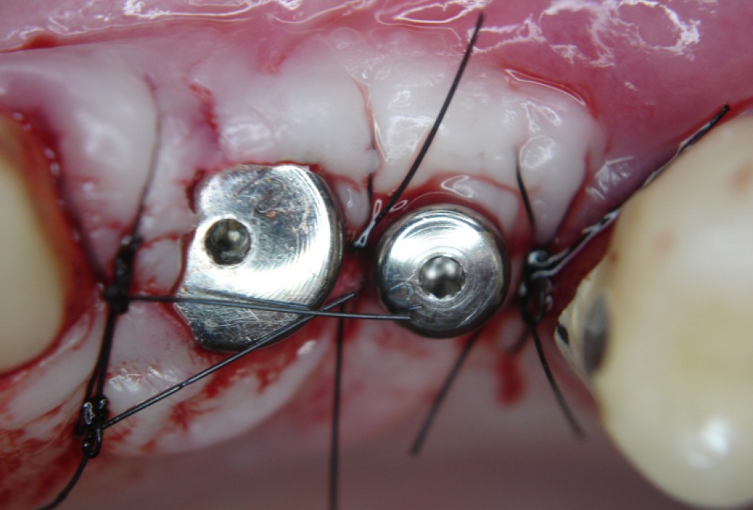 botiss cerabone® & Jason® membrane for GBR - Clinical case by Dr. S. Kovalevsky