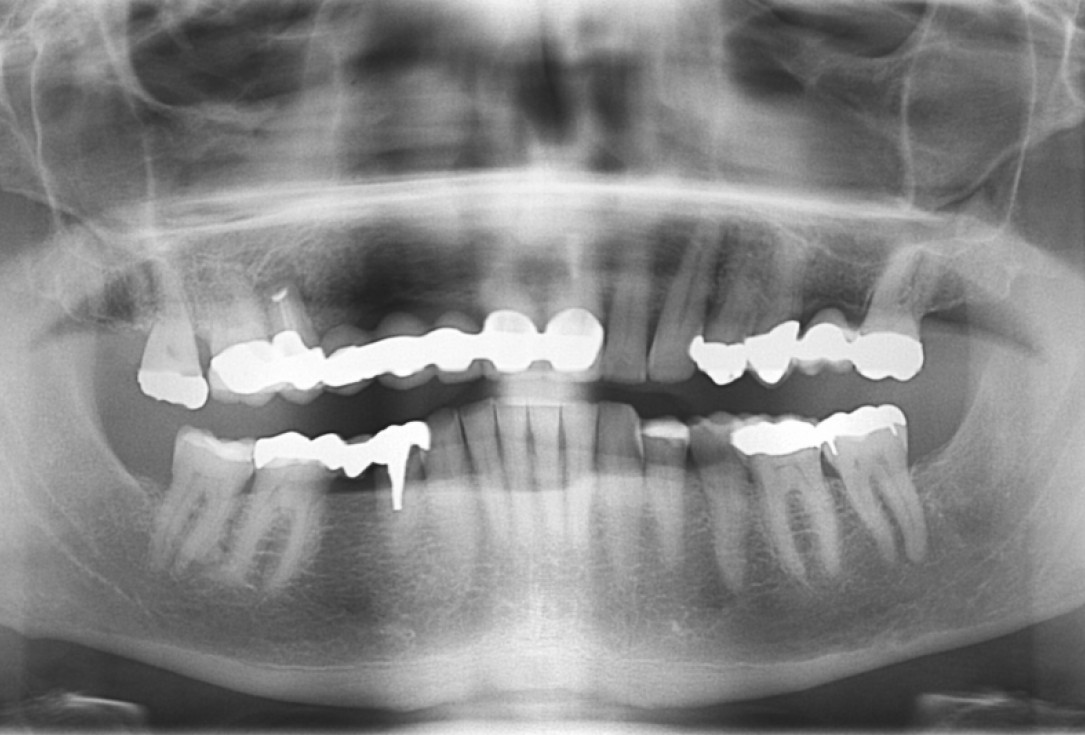 botiss cerabone® & Jason® membrane for GBR - Clinical case by Prof. Dr. Dr. D. Rothamel