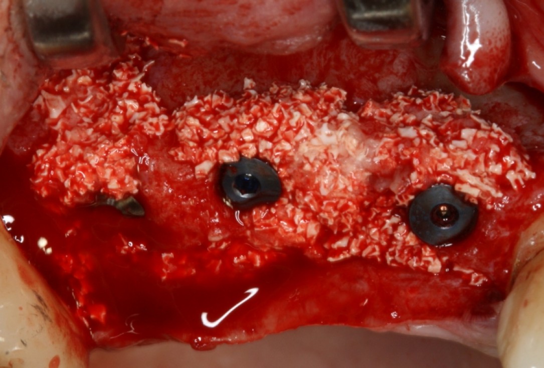 botiss cerabone® & Jason® membrane for GBR - Clinical case by Prof. Dr. Dr. D. Rothamel