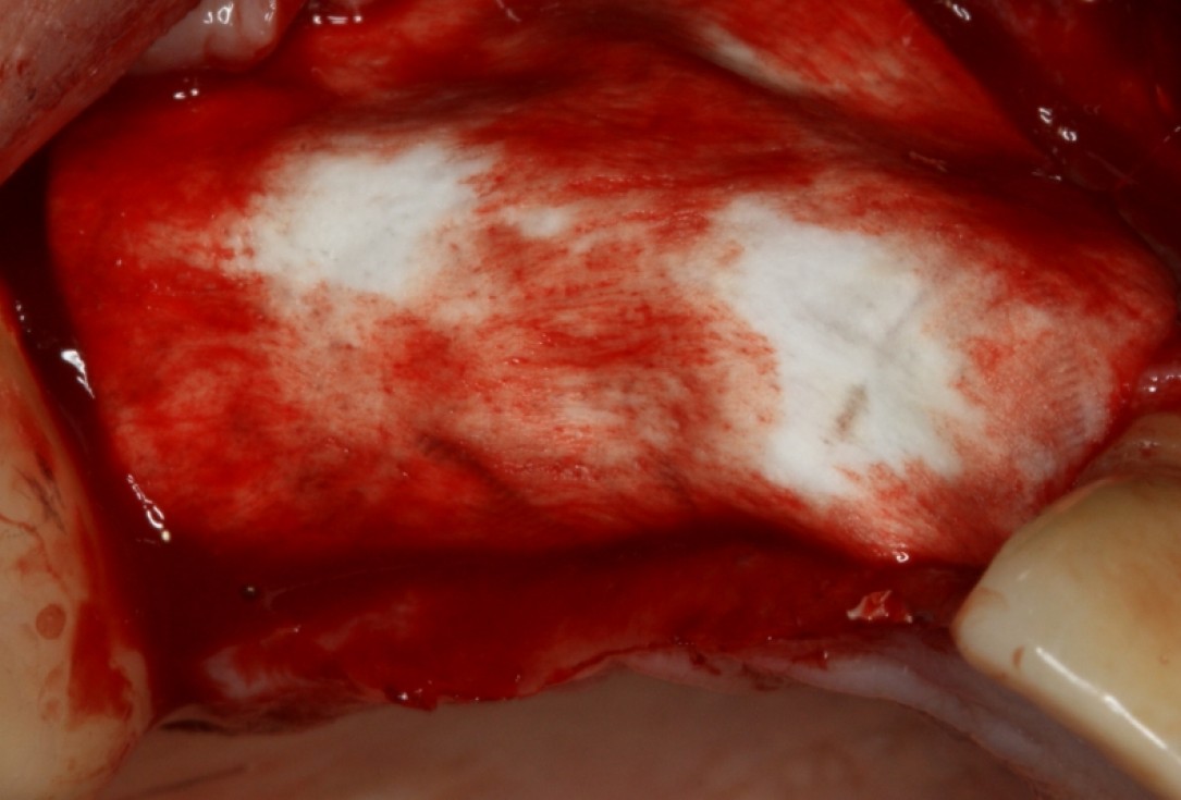 botiss cerabone® & Jason® membrane for GBR - Clinical case by Prof. Dr. Dr. D. Rothamel