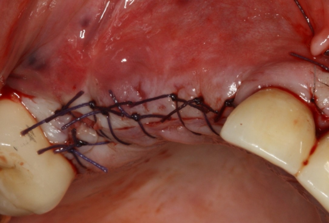 botiss cerabone® & Jason® membrane for GBR - Clinical case by Prof. Dr. Dr. D. Rothamel
