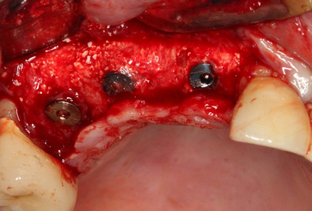 botiss cerabone® & Jason® membrane for GBR - Clinical case by Prof. Dr. Dr. D. Rothamel