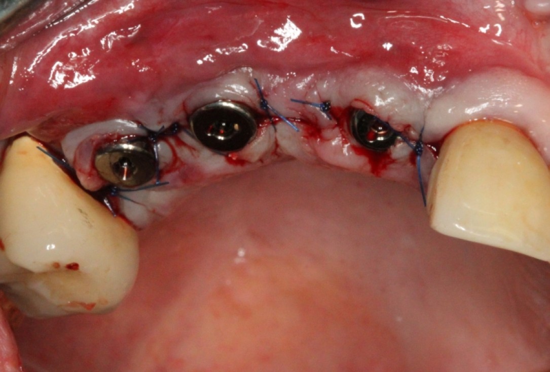 botiss cerabone® & Jason® membrane for GBR - Clinical case by Prof. Dr. Dr. D. Rothamel