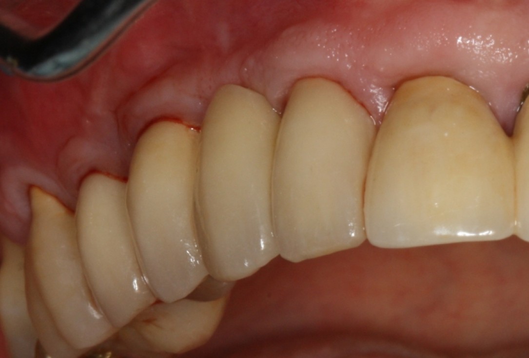 botiss cerabone® & Jason® membrane for GBR - Clinical case by Prof. Dr. Dr. D. Rothamel