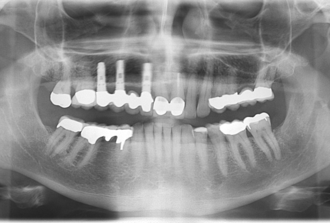 botiss cerabone® & Jason® membrane for GBR - Clinical case by Prof. Dr. Dr. D. Rothamel