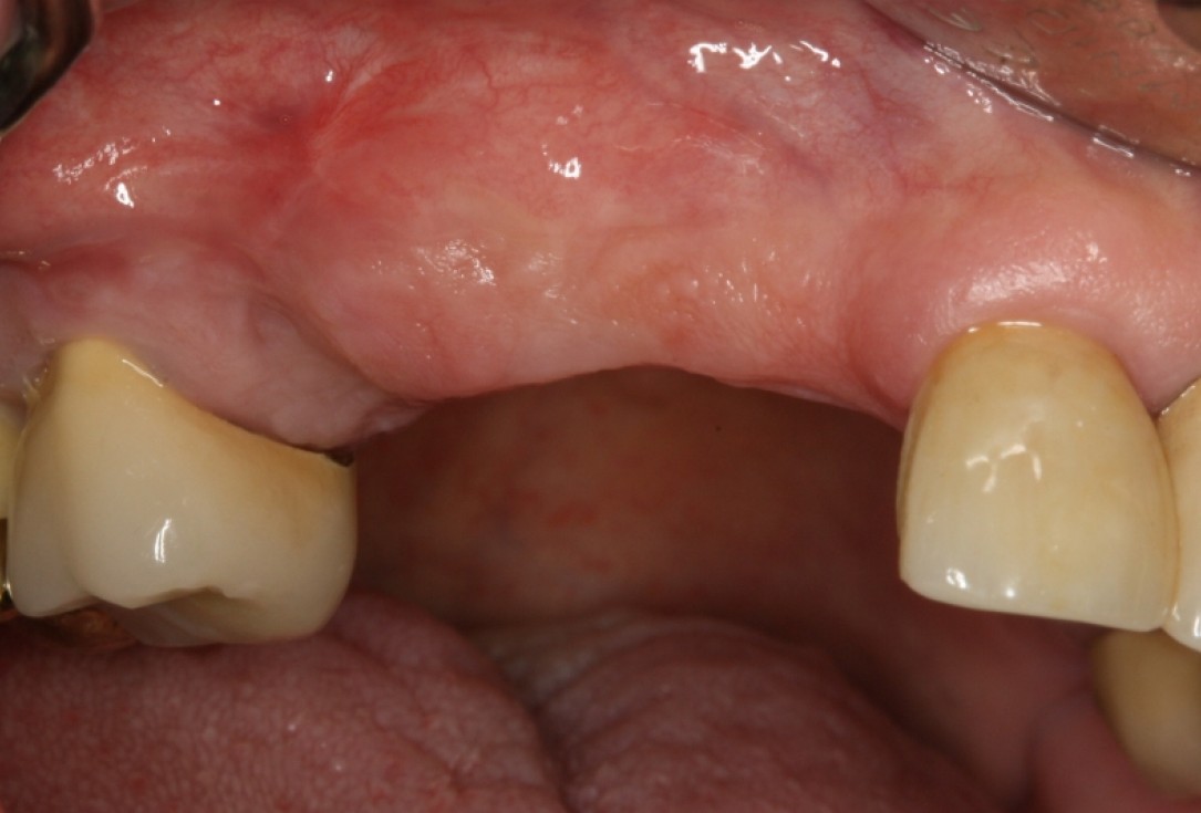 botiss cerabone® & Jason® membrane for GBR - Clinical case by Prof. Dr. Dr. D. Rothamel
