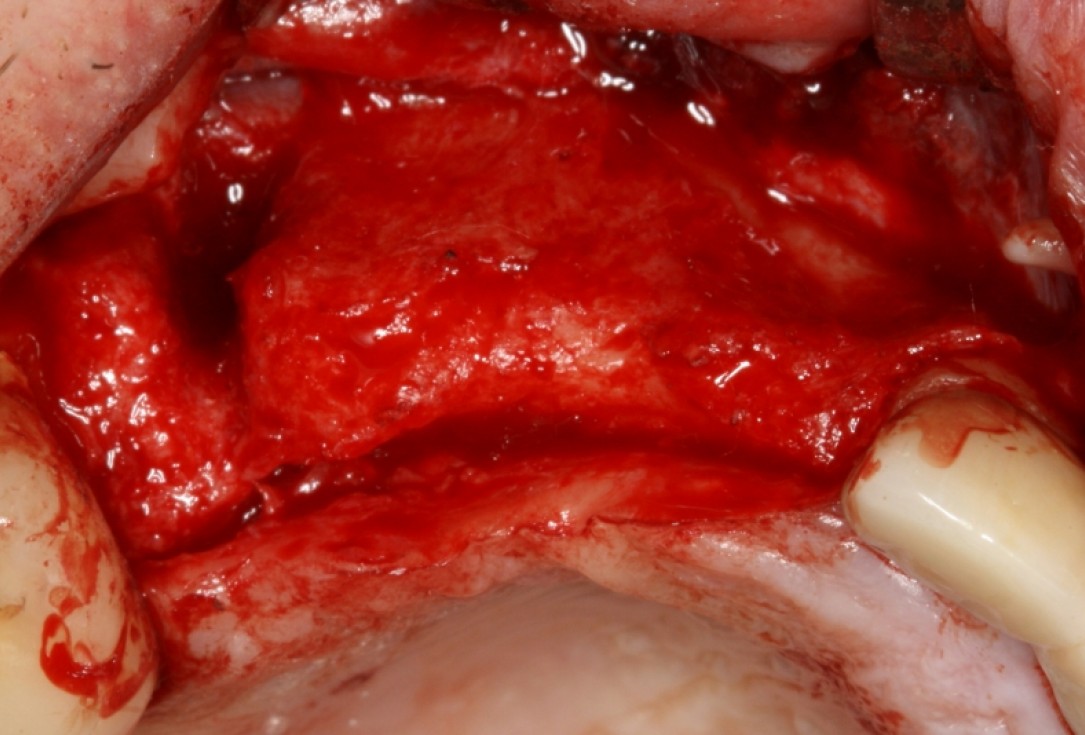 botiss cerabone® & Jason® membrane for GBR - Clinical case by Prof. Dr. Dr. D. Rothamel