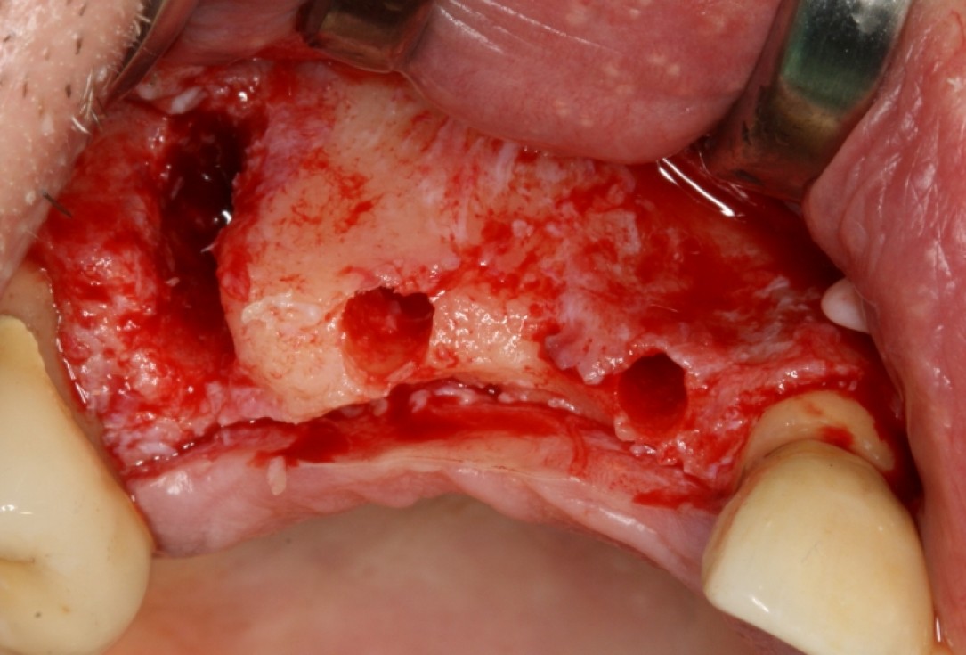 botiss cerabone® & Jason® membrane for GBR - Clinical case by Prof. Dr. Dr. D. Rothamel